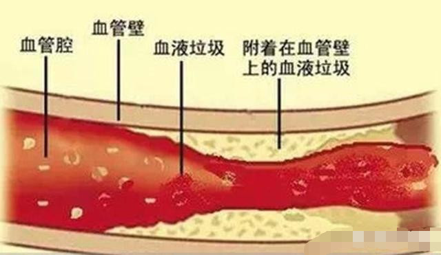 最新血管堵塞治疗方法的研究与应用进展