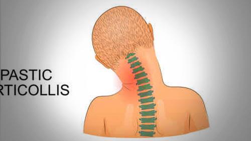 痉挛性斜颈最新治疗研究与应用进展